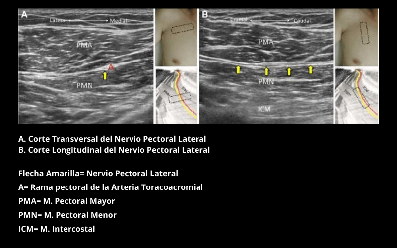 Nervio Pectoral Lateral (1).png